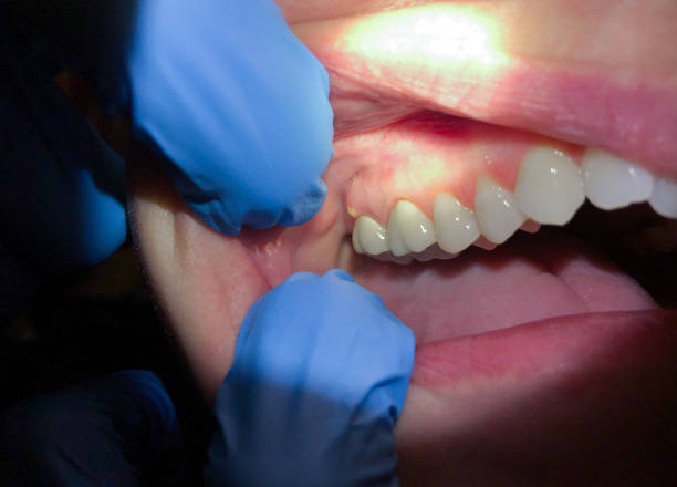 Best Emergency Treatment for Toothache in Burlington, VT